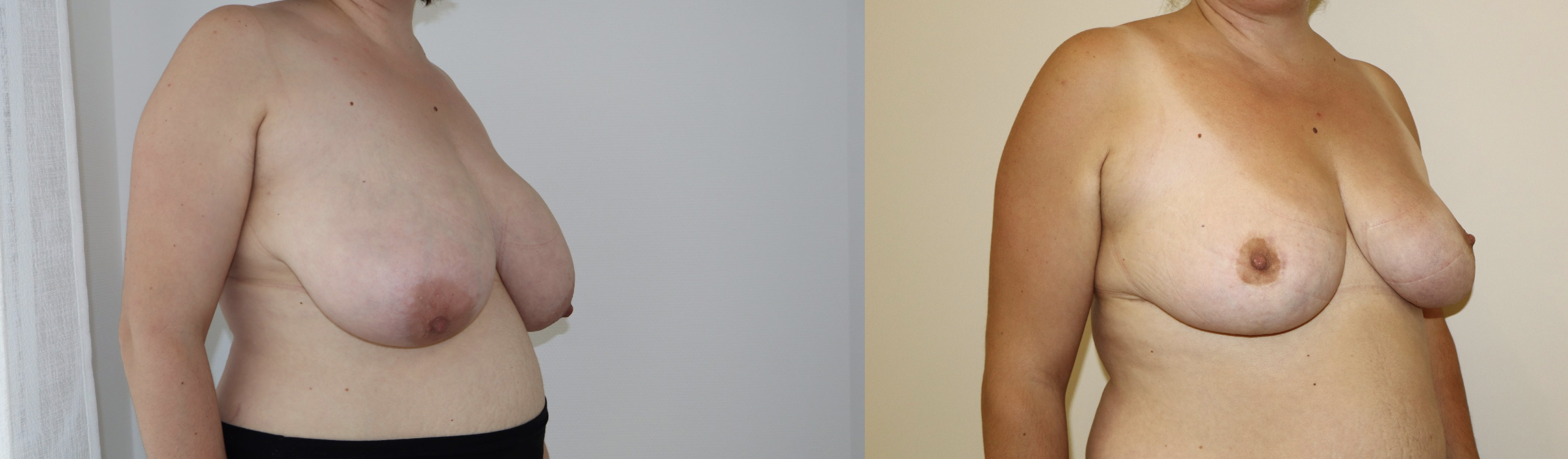 Avant/Après lifting seins et réduction mammaire